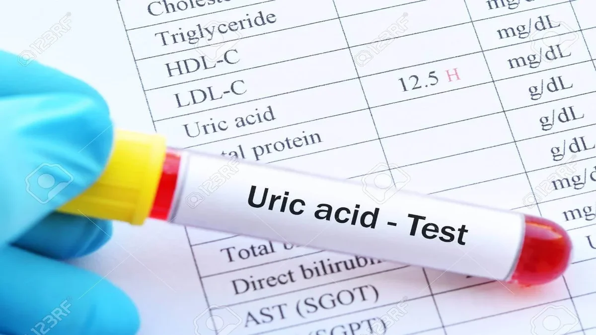 تحليل serum uric acid