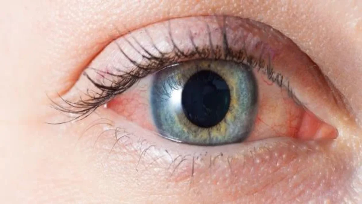 أعراض احمرار العيون عند الأطفال