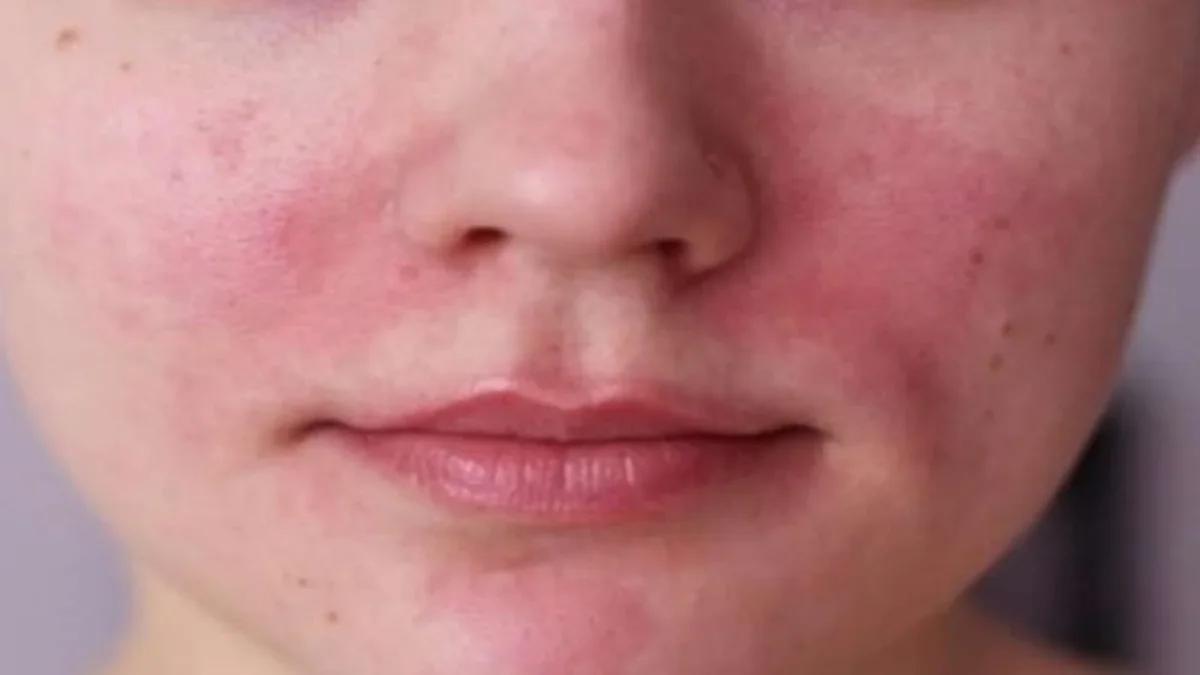 علاج احمرار الوجه وسخونته